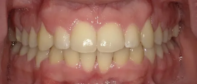 After image