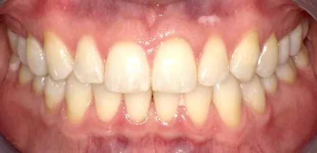 After image