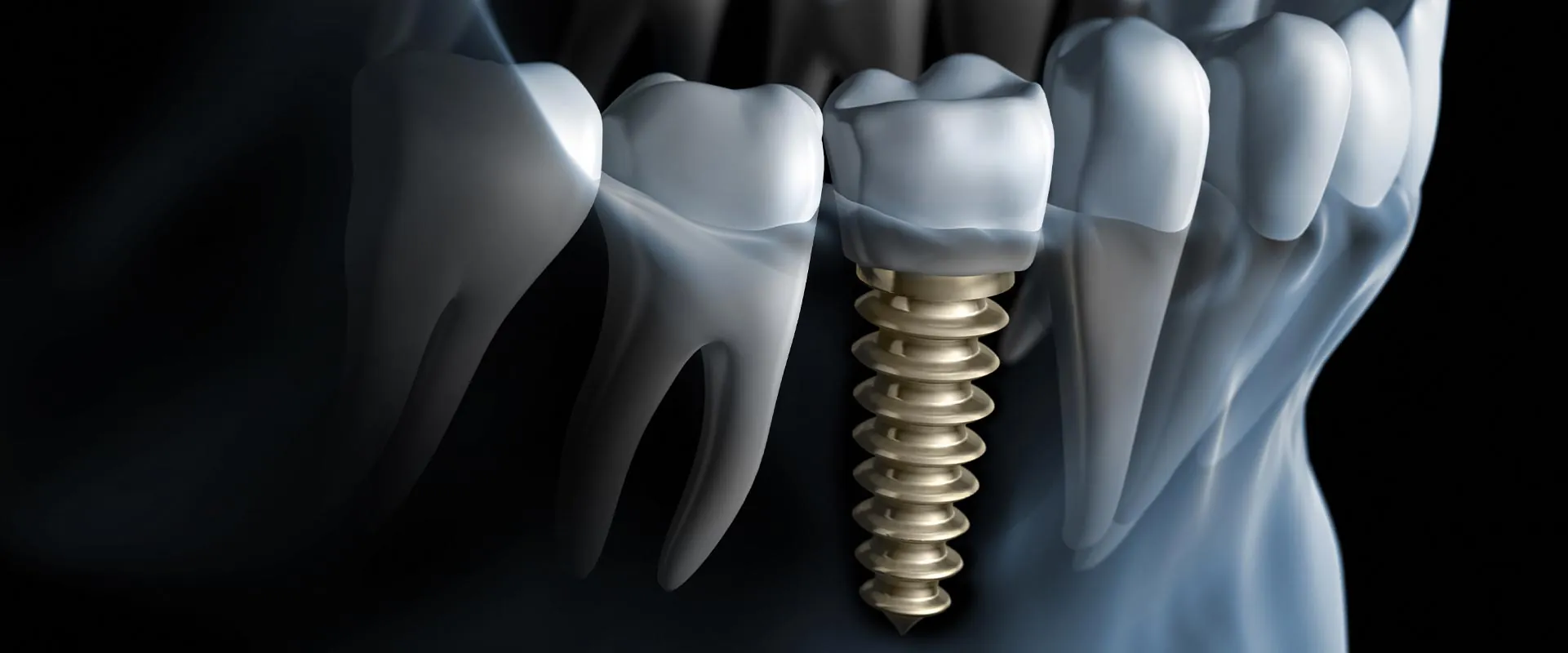 illustration of a single dental implant