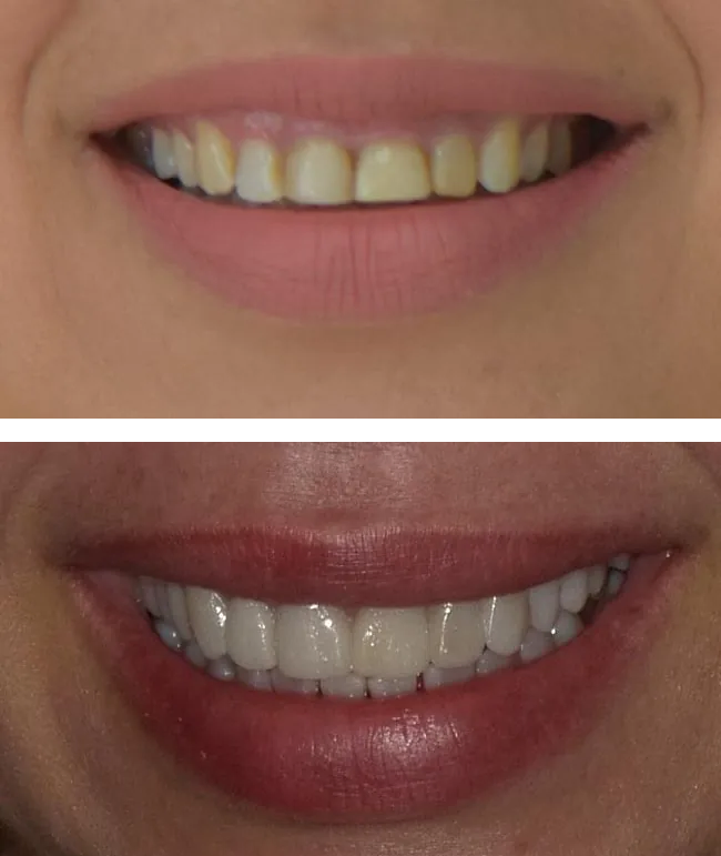 before and after smile makeover at Lake Lucerne Cosmetic and Implant Dentistry