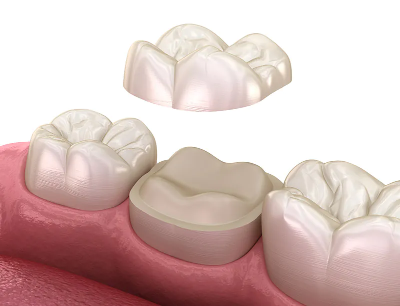 Dental crown illustration over a prepared molar